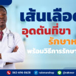 เส้นเลือดดําอุดตันที่ขา รักษา