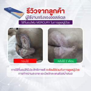 ที่นอนโฟมป้องกันแผลกดทับ Dyna-Form รุ่น Mercury